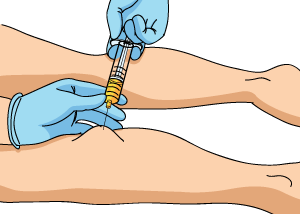 Baker's Cyst Aspiration