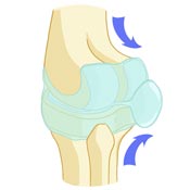 Baker's Cyst Rupture